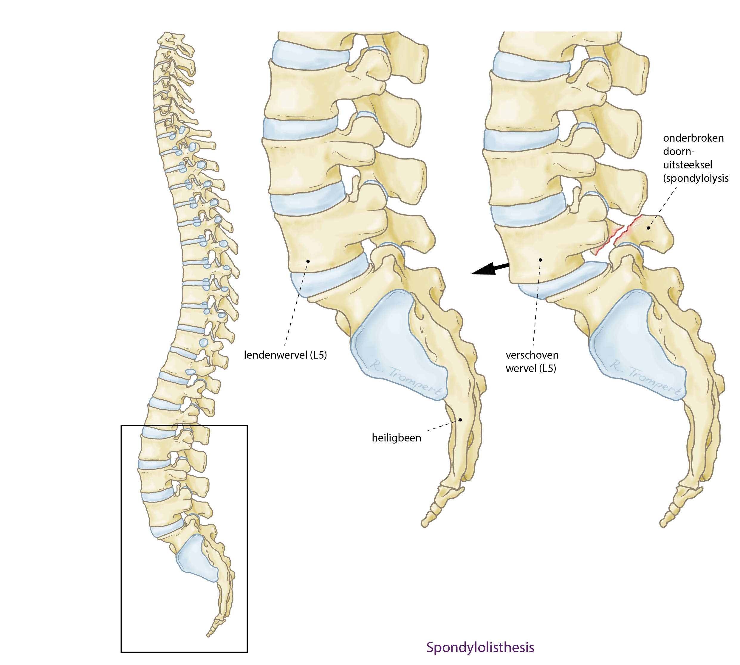 3-2-2-Spondylolisthesis_aangepast (1).png