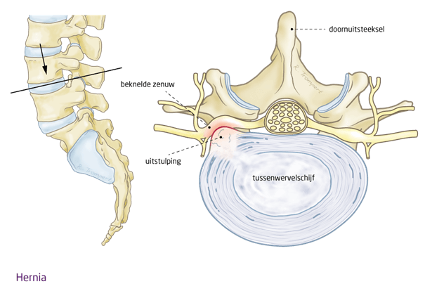 Hernia.png