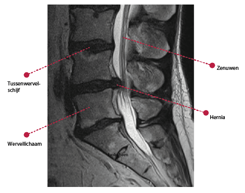 MRI beeld hernia.png